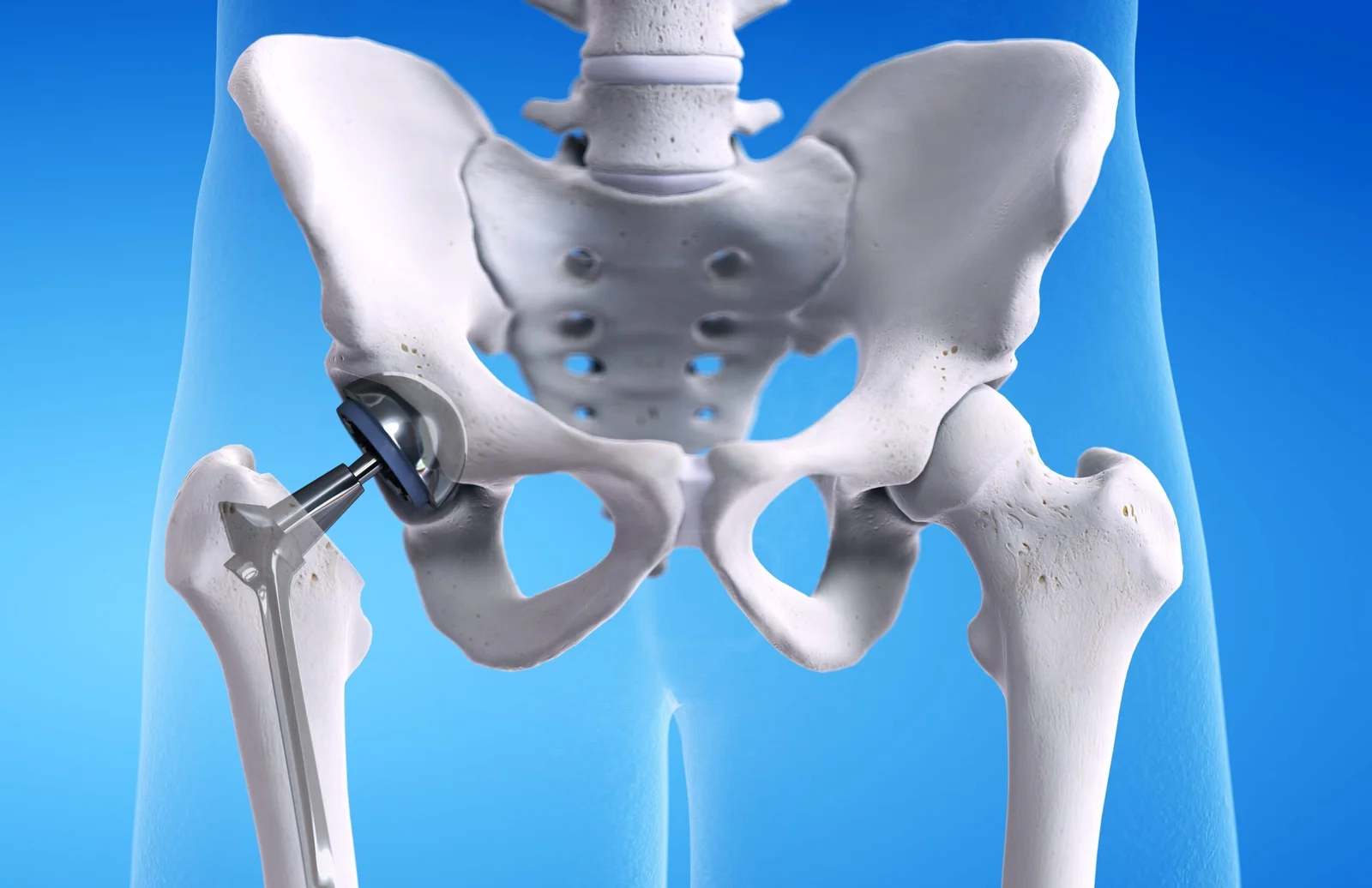 Hip Replacement Surgery in Dubai