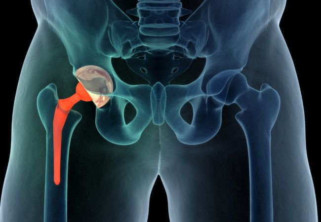 prolianceorthopedicassociatescom Knee Joint Replacement Surgery in Dubai