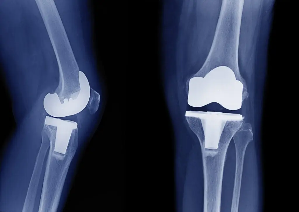 shutterstock 427586062 1024x727 1 Knee Joint Replacement Surgery in Dubai