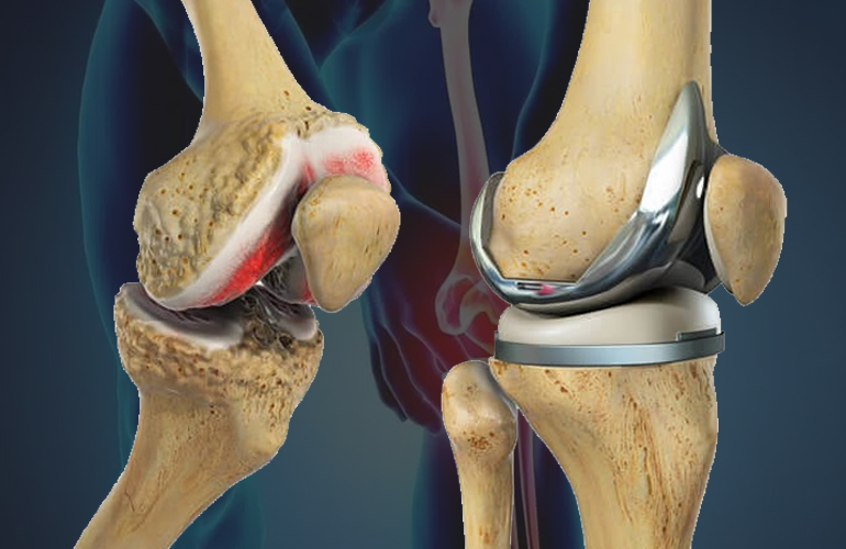 Knee Joint Replacement Surgery in Dubai