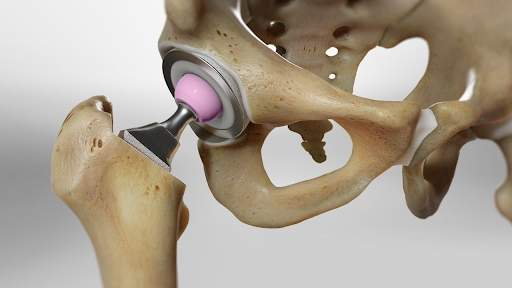 hip arthroscopy Home